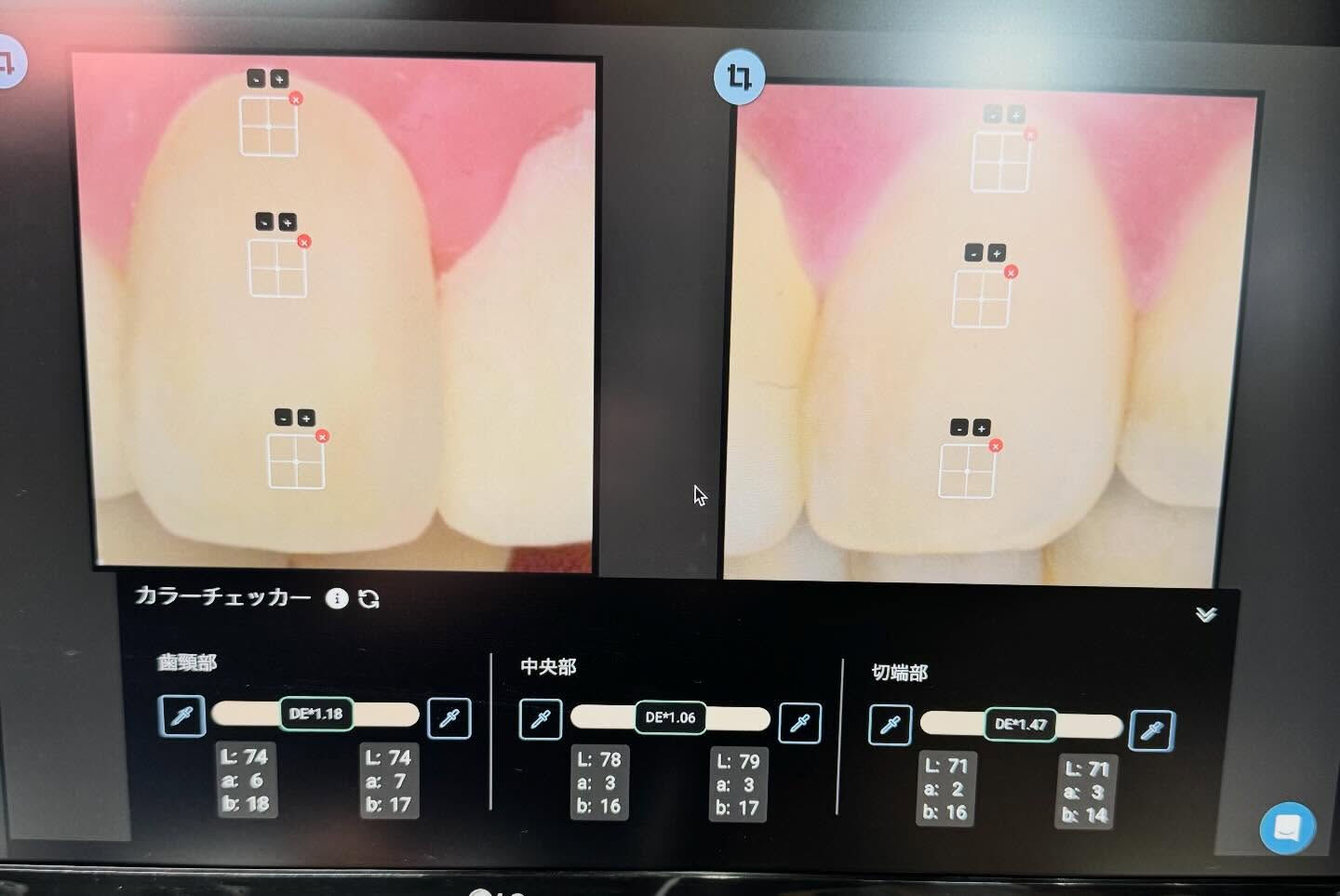 色調再現もかなり難しい技工になりますが、歯冠形態も難しいです
