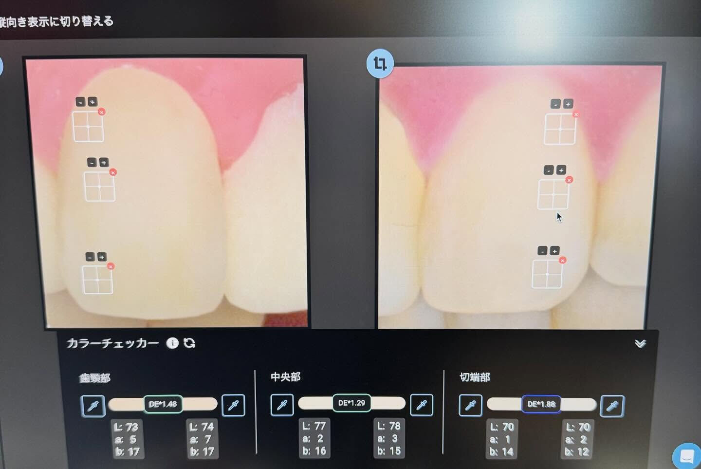 色調再現もかなり難しい技工になりますが、歯冠形態も難しいです