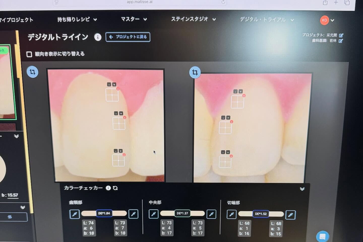色調再現もかなり難しい技工になりますが、歯冠形態も難しいです