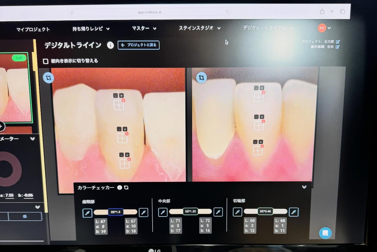 色調再現もかなり難しい技工になりますが、歯冠形態も難しいです