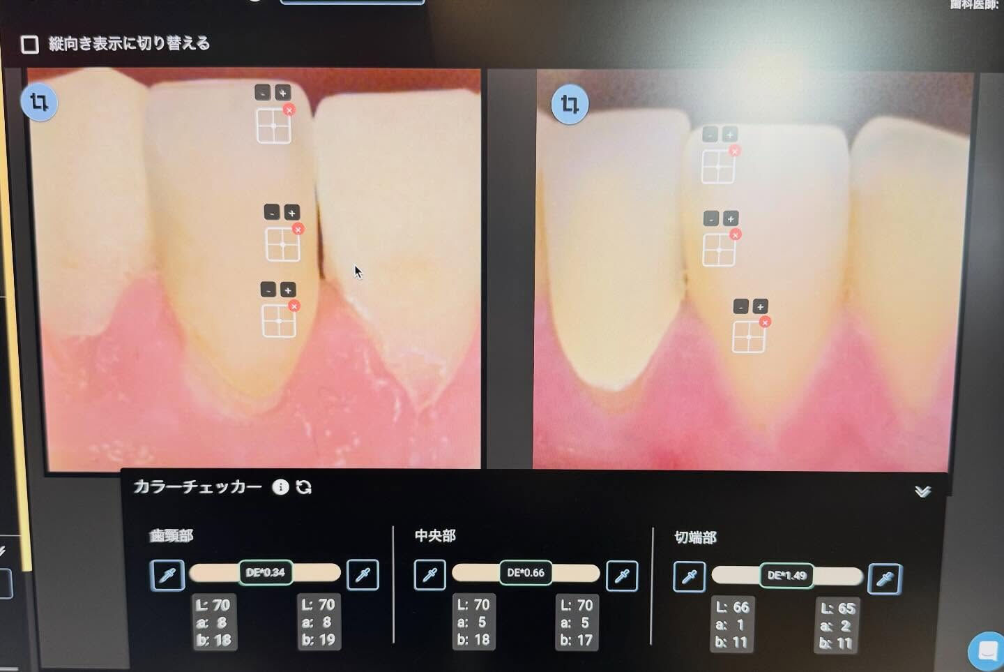色調再現もかなり難しい技工になりますが、歯冠形態も難しいです
