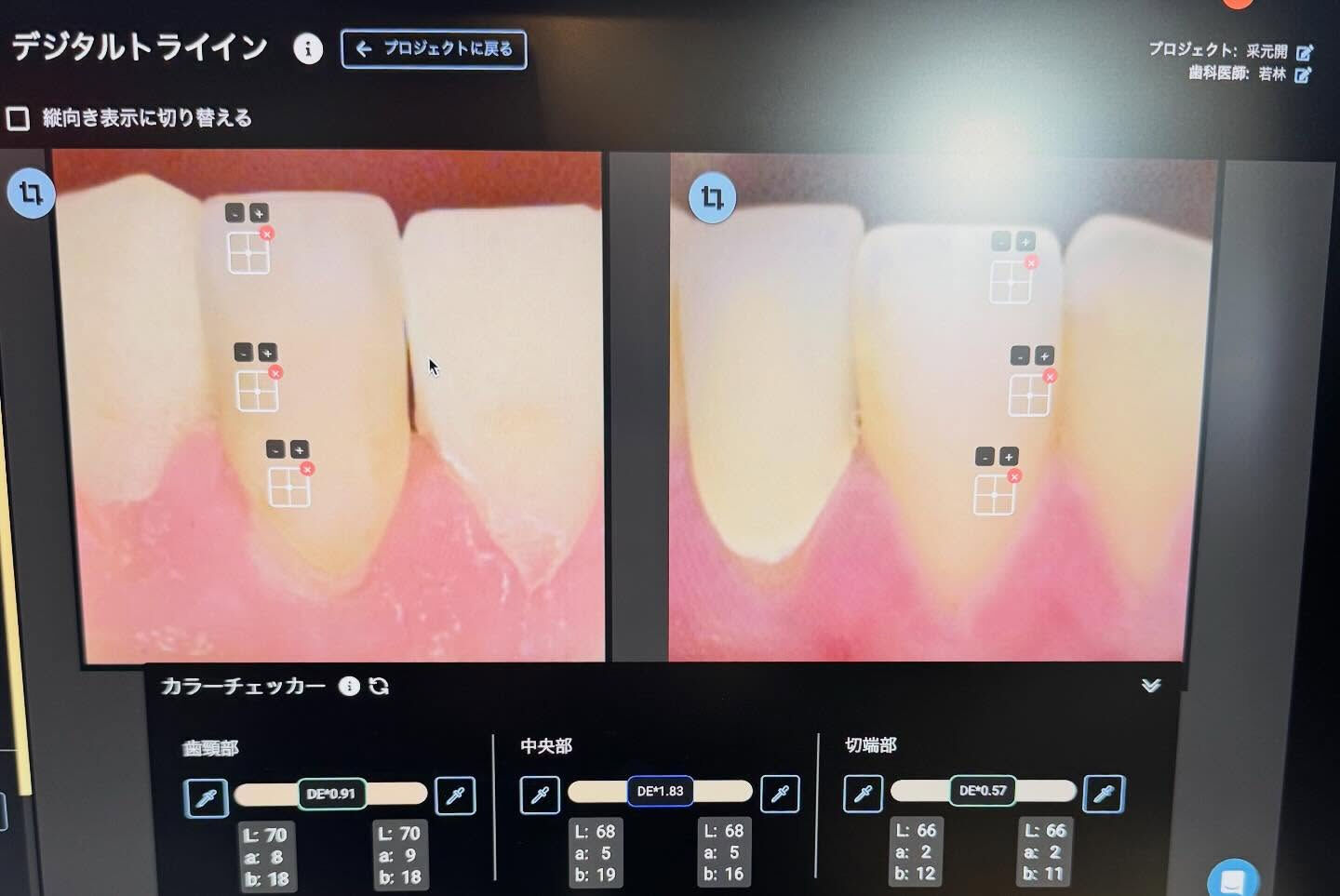 色調再現もかなり難しい技工になりますが、歯冠形態も難しいです